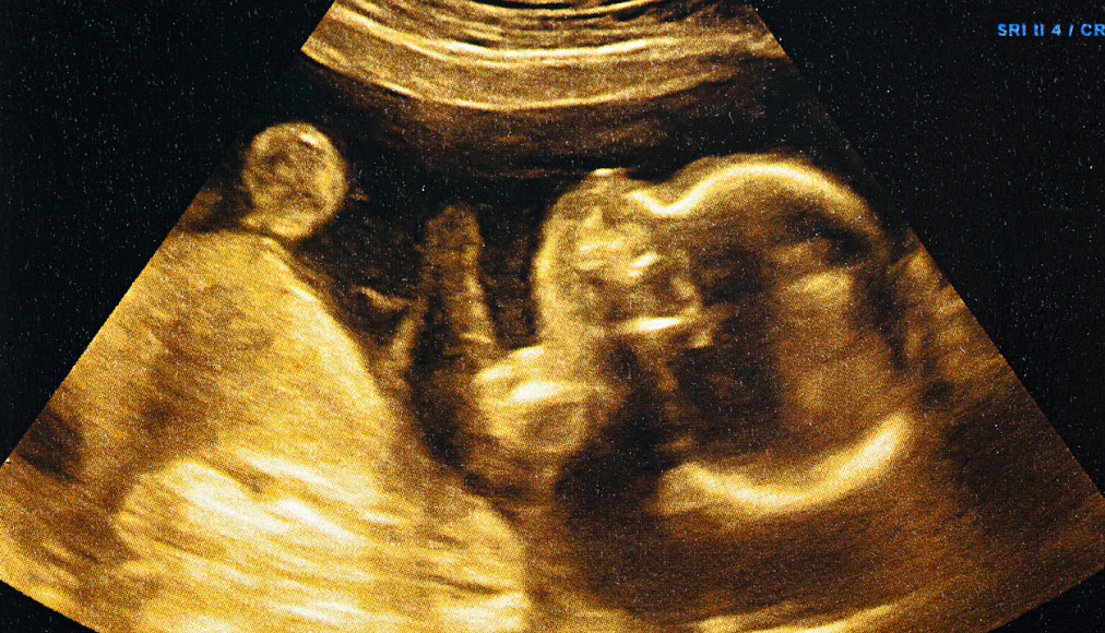 Don de sperme, mère porteuse, droit à l’enfant et droit du co-géniteur: autant de questions qui font débat Don de sperme, mère porteuse, droit à l’enfant et droit du co-géniteur: autant de questions qui font débat / IStock
